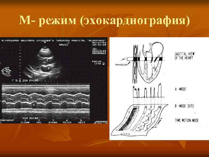 М- режим (эхокардиография) 