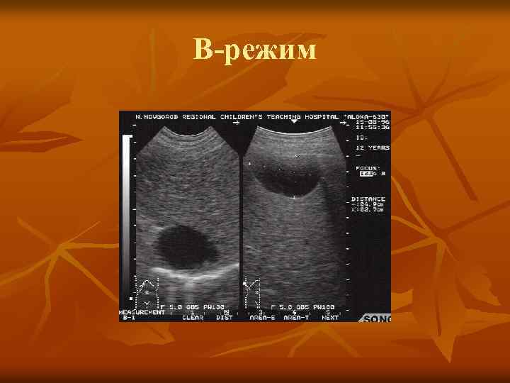 В-режим 