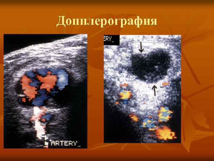 Допплерография 