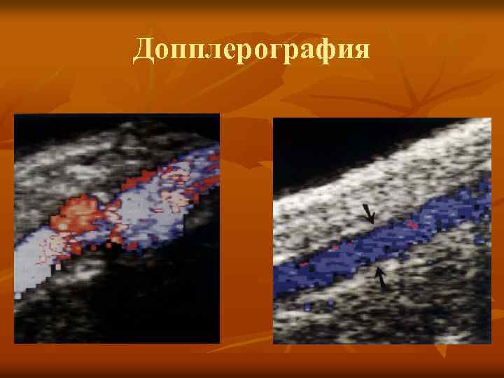 Допплерография 