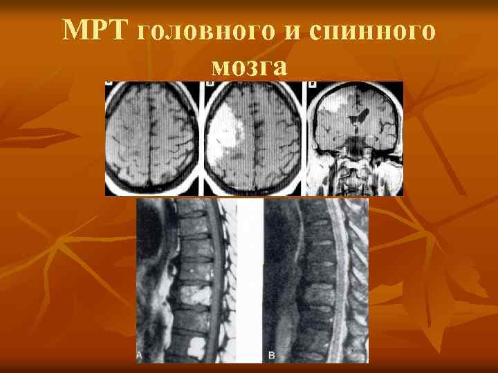 МРТ головного и спинного мозга 