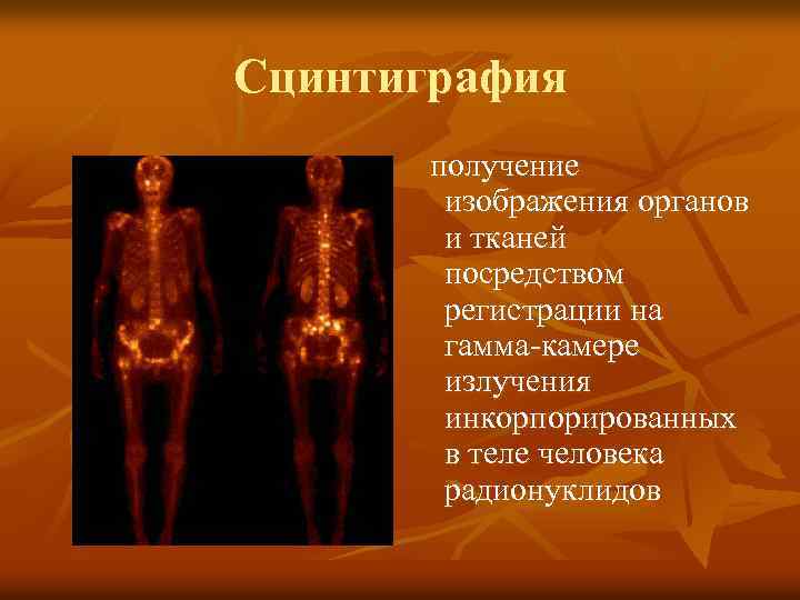Сцинтиграфия получение изображения органов и тканей посредством регистрации на гамма-камере излучения инкорпорированных в теле