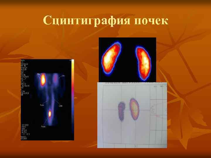 Сцинтиграфия почек 