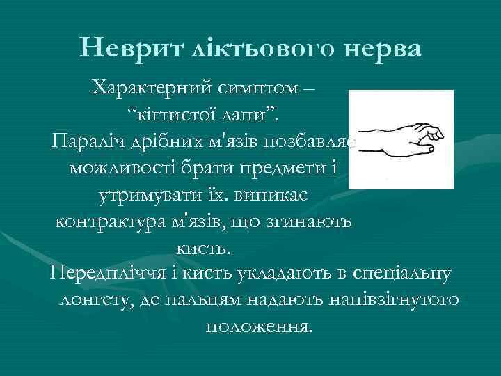 Неврит ліктьового нерва Характерний симптом – “кігтистої лапи”. Параліч дрібних м'язів позбавляє можливості брати