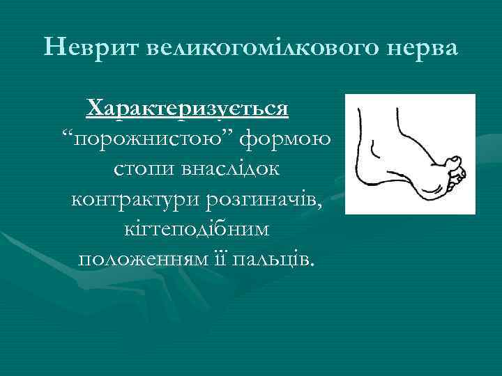 Неврит великогомілкового нерва Характеризується “порожнистою” формою стопи внаслідок контрактури розгиначів, кігтеподібним положенням її пальців.