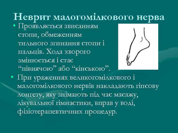 Неврит малогомілкового нерва • Проявляється звисанням стопи, обмеженням тильного згинання стопи і пальців. Хода