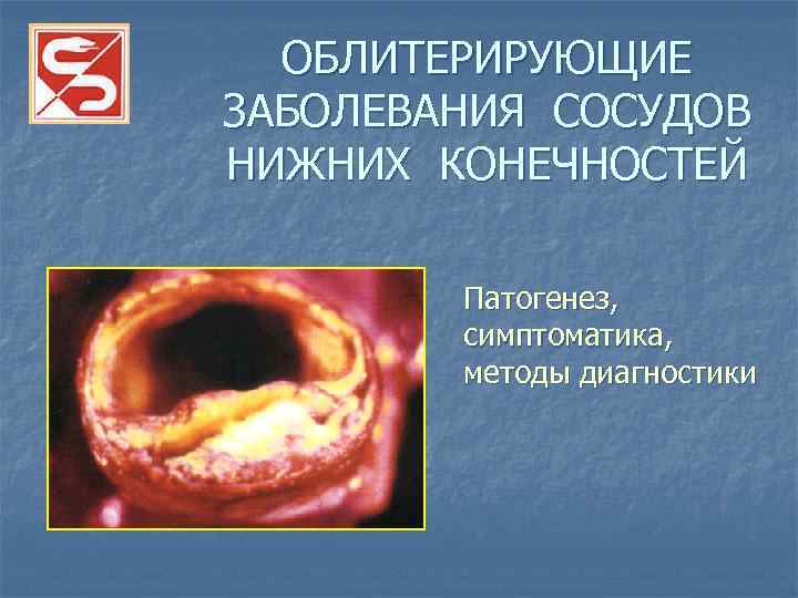 ОБЛИТЕРИРУЮЩИЕ ЗАБОЛЕВАНИЯ СОСУДОВ НИЖНИХ КОНЕЧНОСТЕЙ Патогенез, симптоматика, методы диагностики 