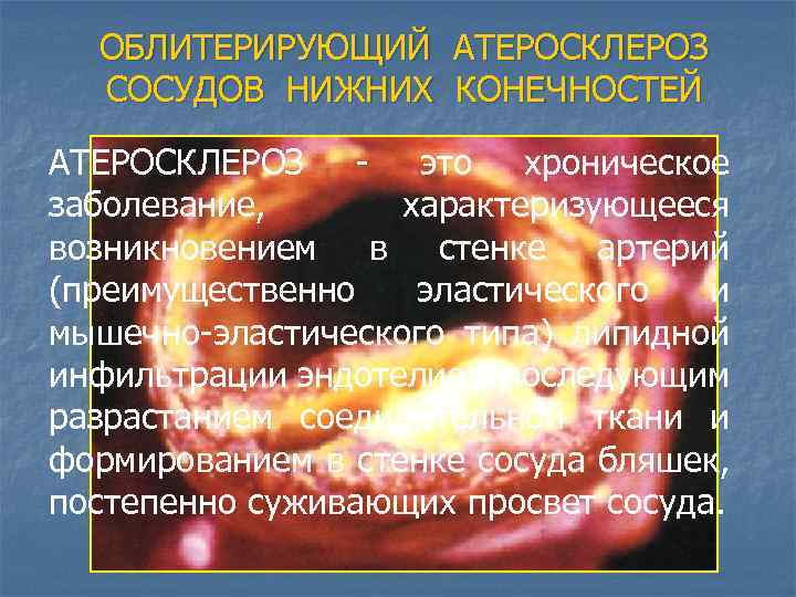 ОБЛИТЕРИРУЮЩИЙ АТЕРОСКЛЕРОЗ СОСУДОВ НИЖНИХ КОНЕЧНОСТЕЙ АТЕРОСКЛЕРОЗ - это хроническое заболевание, характеризующееся возникновением в стенке