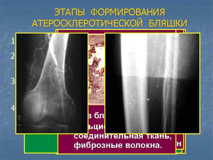 ЭТАПЫ ФОРМИРОВАНИЯ АТЕРОСКЛЕРОТИЧЕСКОЙ БЛЯШКИ 1. Повреждение эндотелия 2. Проникновение липидов в стенку сосуда –