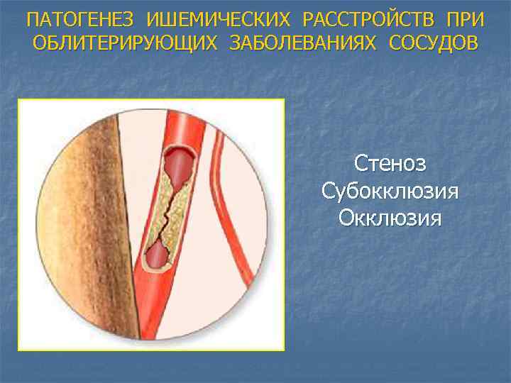 ПАТОГЕНЕЗ ИШЕМИЧЕСКИХ РАССТРОЙСТВ ПРИ ОБЛИТЕРИРУЮЩИХ ЗАБОЛЕВАНИЯХ СОСУДОВ Стеноз Субокклюзия Окклюзия 