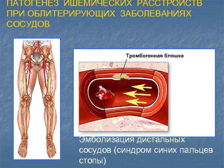 ПАТОГЕНЕЗ ИШЕМИЧЕСКИХ РАССТРОЙСТВ ПРИ ОБЛИТЕРИРУЮЩИХ ЗАБОЛЕВАНИЯХ СОСУДОВ Эмболизация дистальных сосудов (синдром синих пальцев стопы)