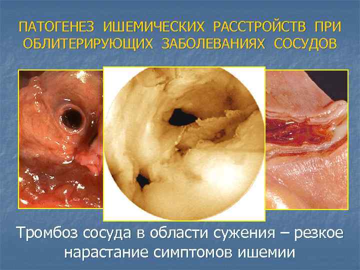 ПАТОГЕНЕЗ ИШЕМИЧЕСКИХ РАССТРОЙСТВ ПРИ ОБЛИТЕРИРУЮЩИХ ЗАБОЛЕВАНИЯХ СОСУДОВ Тромбоз сосуда в области сужения – резкое