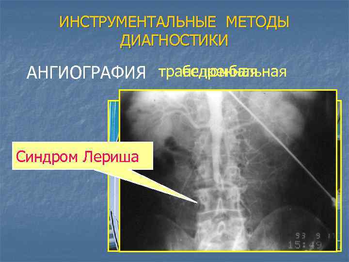 ИНСТРУМЕНТАЛЬНЫЕ МЕТОДЫ ДИАГНОСТИКИ бедренная АНГИОГРАФИЯ транслюмбальная Синдром Лериша 
