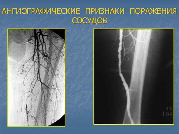 АНГИОГРАФИЧЕСКИЕ ПРИЗНАКИ ПОРАЖЕНИЯ СОСУДОВ 