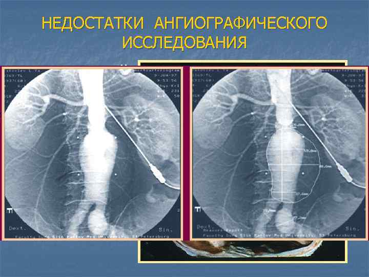 НЕДОСТАТКИ АНГИОГРАФИЧЕСКОГО ИССЛЕДОВАНИЯ 1. Инвазивный метод 2. Необходимость введения контрастного препарата (токсичность, аллергия) 3.
