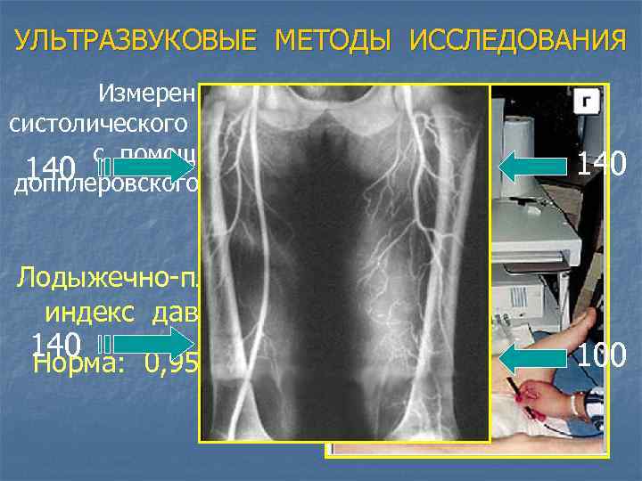 УЛЬТРАЗВУКОВЫЕ МЕТОДЫ ИССЛЕДОВАНИЯ Измерение систолического давления с помощью 140 допплеровского датчика 140 Лодыжечно-плечевой индекс