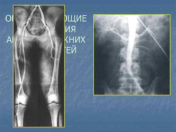 ОБЛИТЕРИРУЮЩИЕ ЗАБОЛЕВАНИЯ АРТЕРИЙ НИЖНИХ КОНЕЧНОСТЕЙ 
