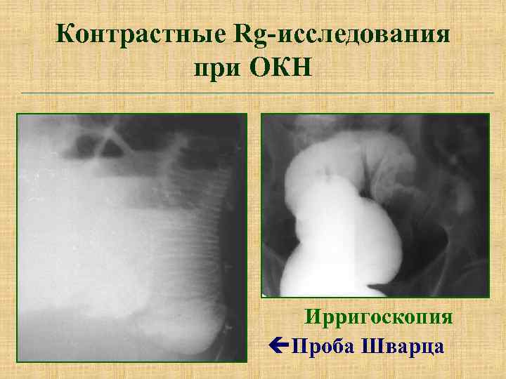 Контрастные Rg-исследования при ОКН Ирригоскопия çПроба Шварца 