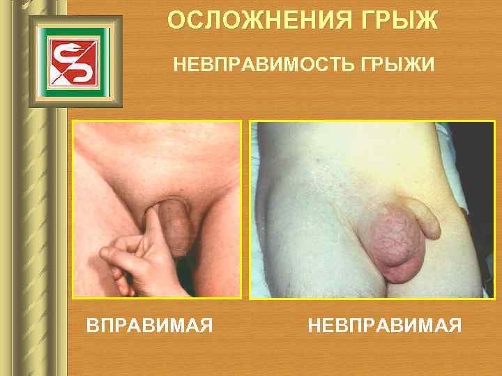 ОСЛОЖНЕНИЯ ГРЫЖ НЕВПРАВИМОСТЬ ГРЫЖИ ВПРАВИМАЯ НЕВПРАВИМАЯ 