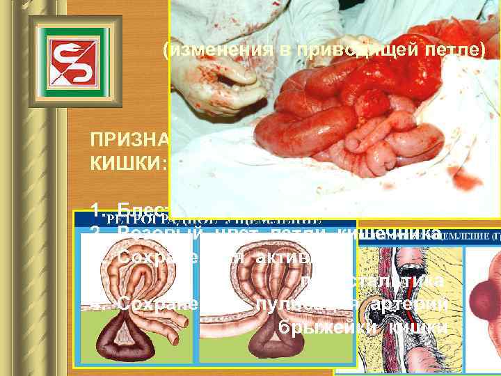 ОСЛОЖНЕНИЯ ГРЫЖ (изменения в приводящей петле) УЩЕМЛЕНИЕ ГРЫЖИ ПРИЗНАКА ЖИЗНЕСПОСОБНОСТИ КИШКИ: 1. Блестящая серозная