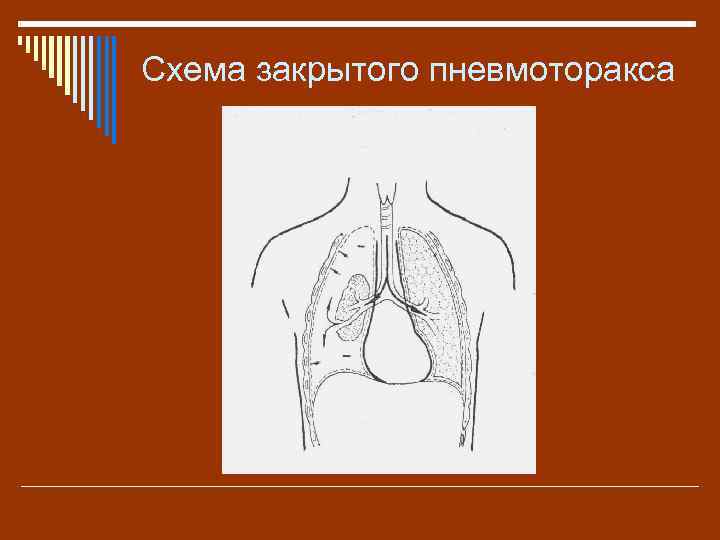 Спонтанный пневмоторакс карта вызова скорой медицинской