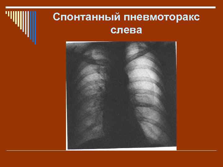 Спонтанный пневмоторакс слева 