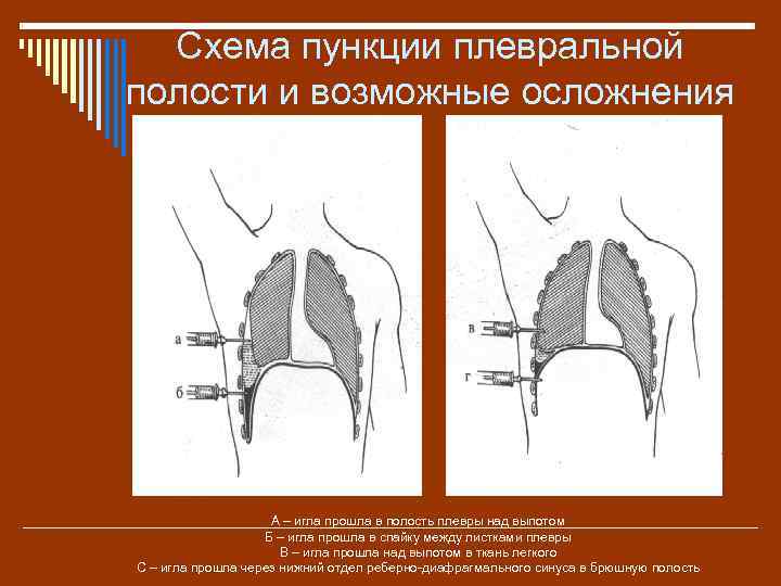 Схема пункции плевральной полости и возможные осложнения А – игла прошла в полость плевры