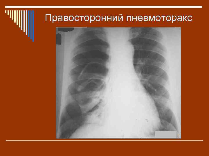 Правосторонний пневмоторакс 