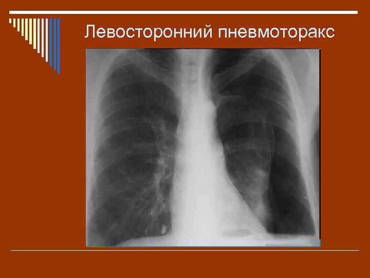Левосторонний пневмоторакс 