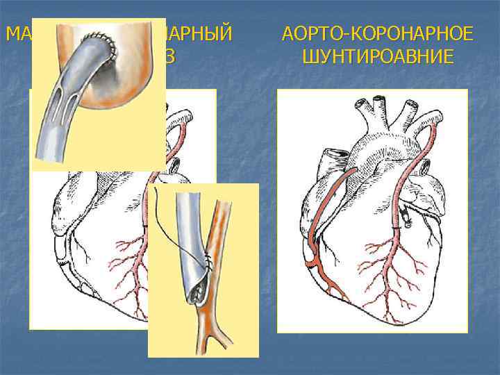 МАММАРО-КОРОНАРНЫЙ АНАСТОМОЗ АОРТО-КОРОНАРНОЕ ШУНТИРОАВНИЕ 