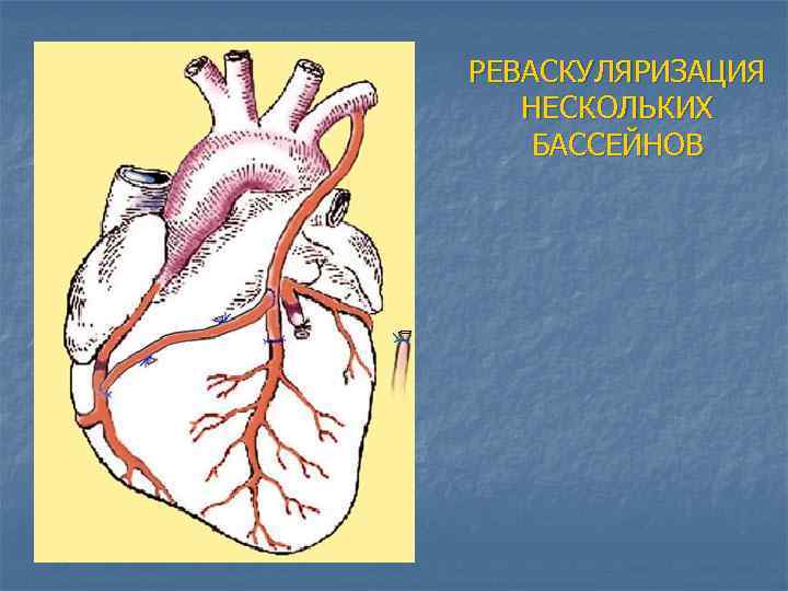 РЕВАСКУЛЯРИЗАЦИЯ НЕСКОЛЬКИХ БАССЕЙНОВ 