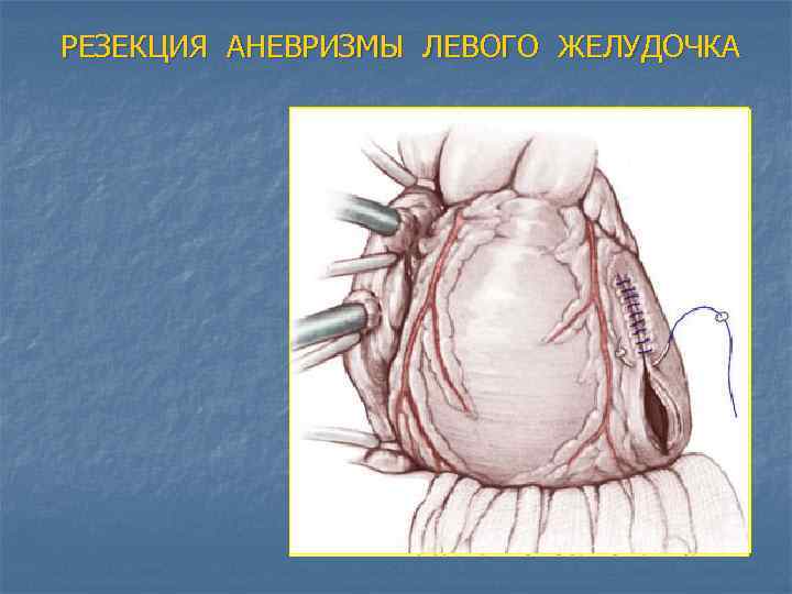 РЕЗЕКЦИЯ АНЕВРИЗМЫ ЛЕВОГО ЖЕЛУДОЧКА 
