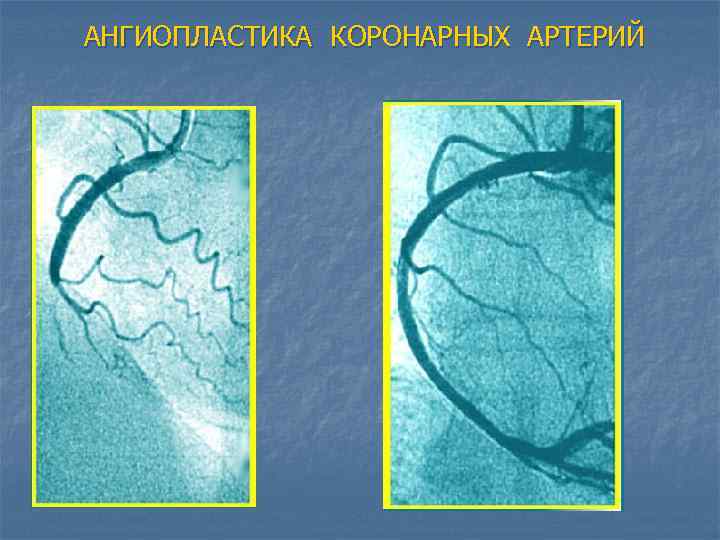АНГИОПЛАСТИКА КОРОНАРНЫХ АРТЕРИЙ 