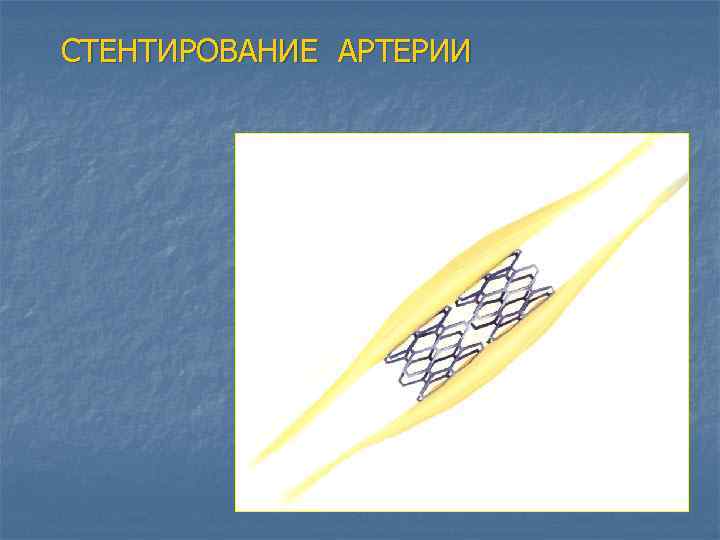 СТЕНТИРОВАНИЕ АРТЕРИИ 