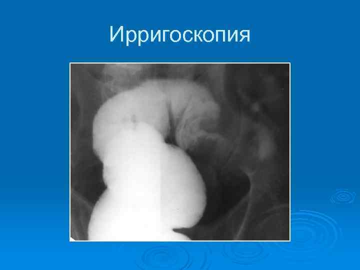 Ирригоскопия 