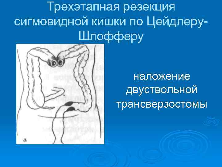 Трехэтапная резекция сигмовидной кишки по Цейдлеру Шлофферу наложение двуствольной трансверзостомы 