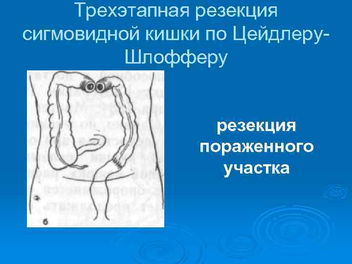 Трехэтапная резекция сигмовидной кишки по Цейдлеру Шлофферу резекция пораженного участка 