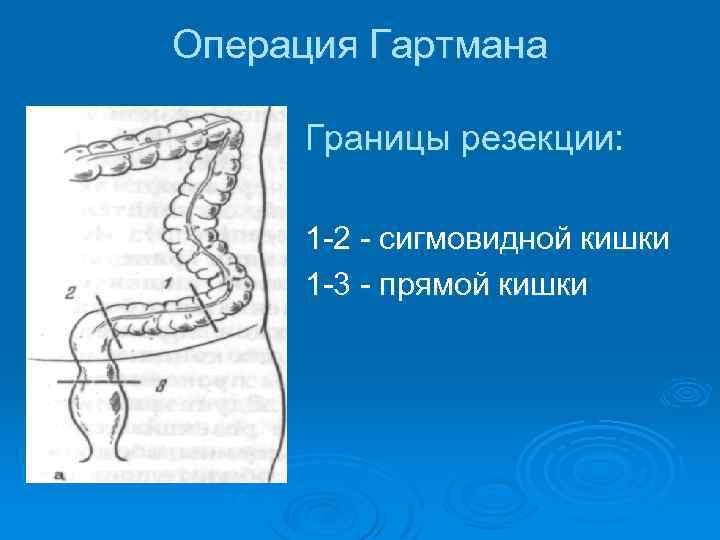 Операция Гартмана Границы резекции: 1 2 сигмовидной кишки 1 3 прямой кишки 