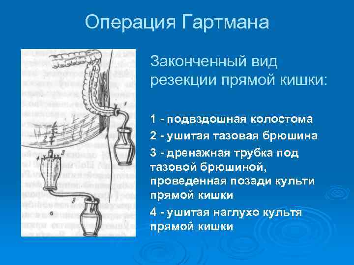 Операция Гартмана Законченный вид резекции прямой кишки: 1 - подвздошная колостома 2 - ушитая