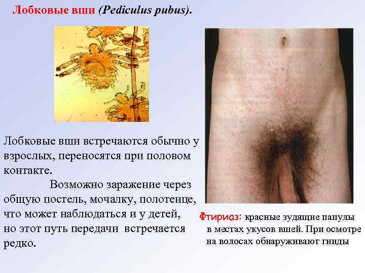 Лобковые вши (Pediculus рubus). Лобковые вши встречаются обычно у взрослых, переносятся при половом контакте.