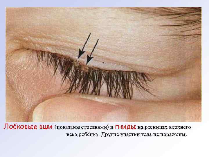 Лобковые вши (показаны стрелками) и гниды на ресницах верхнего века ребёнка. Другие участки тела