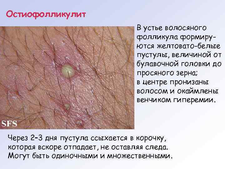 Остиофолликулит В устье волосяного фолликула формируются желтовато-белые пустулы, величиной от булавочной головки до просяного