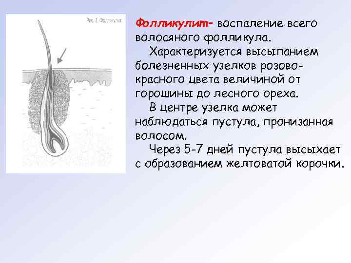 Фолликулит – воспаление всего волосяного фолликула. Характеризуется высыпанием болезненных узелков розовокрасного цвета величиной от