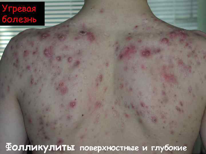 Угревая болезнь Фолликулиты поверхностные и глубокие 