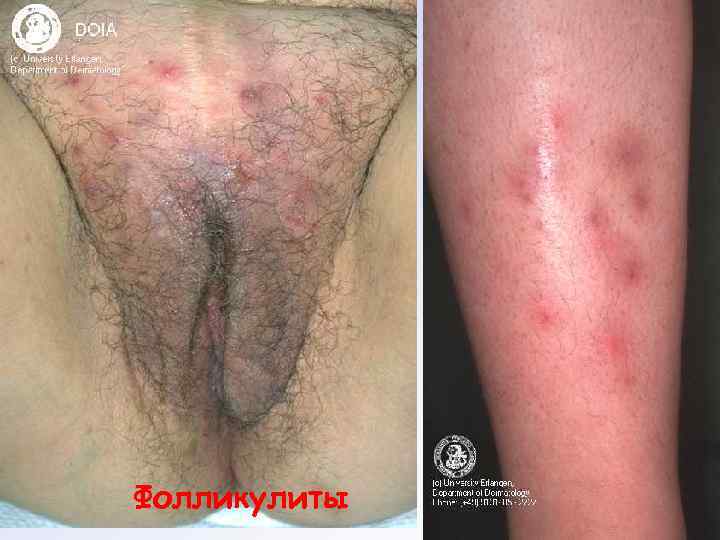 Фолликулиты 
