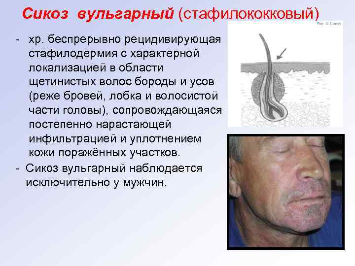 Сикоз вульгарный (стафилококковый) - хр. беспрерывно рецидивирующая стафилодермия с характерной локализацией в области щетинистых