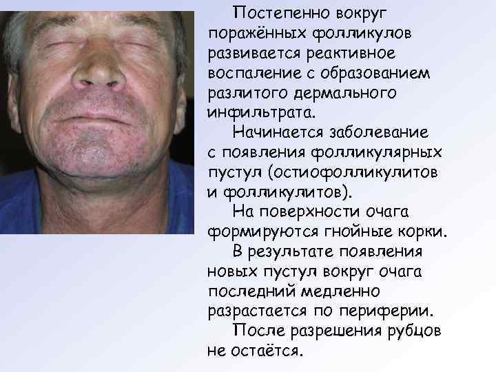 Постепенно вокруг поражённых фолликулов развивается реактивное воспаление с образованием разлитого дермального инфильтрата. Начинается заболевание