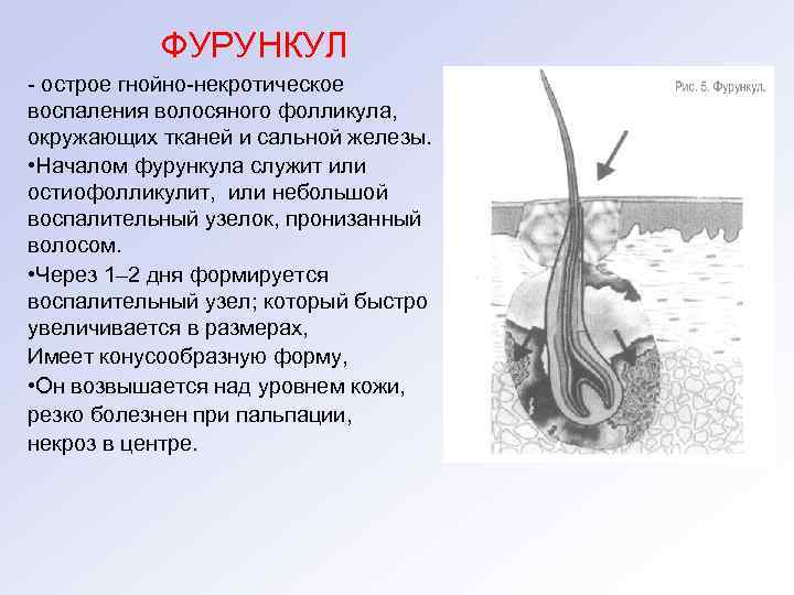 ФУРУНКУЛ - острое гнойно-некротическое воспаления волосяного фолликула, окружающих тканей и сальной железы. • Началом