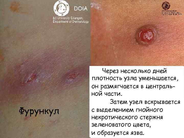 Фурункул Через несколько дней плотность узла уменьшается, он размягчается в центральной части. Затем узел