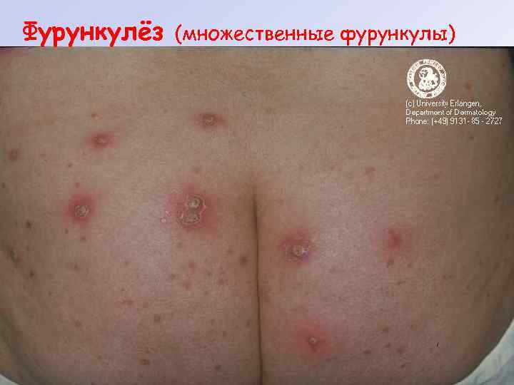 Фурункулёз (множественные фурункулы) 